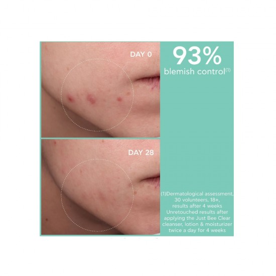 Apivita Lotion κατά της Ακμής Just Bee Clear για Λιπαρές Επιδερμίδες 200ml Apivita Lotion κατά της Ακμής Just Bee Clear για Λιπαρές Επιδερμίδες 200ml